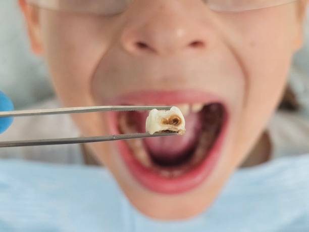 Best Broken or Chipped Tooth Repair in Glasco, NY